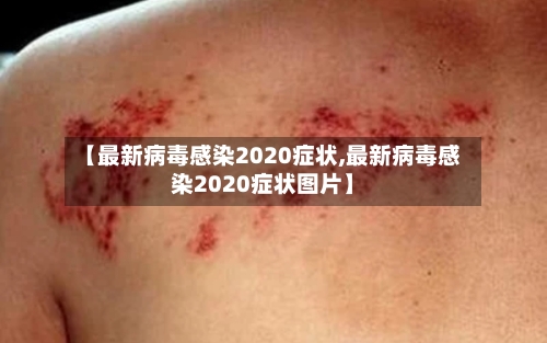 【最新病毒感染2020症状,最新病毒感染2020症状图片】