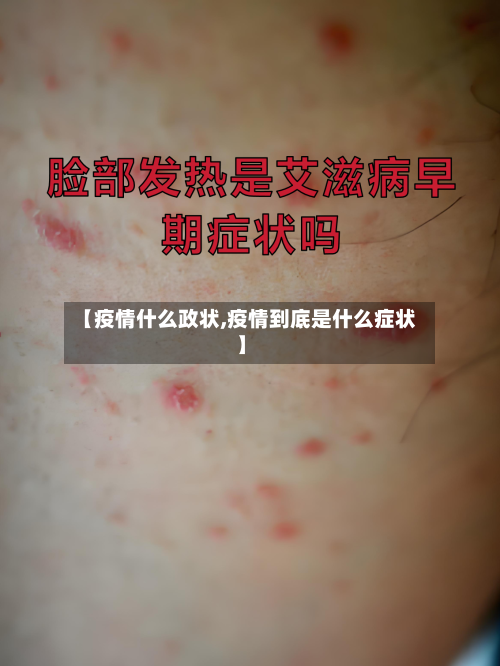 【疫情什么政状,疫情到底是什么症状】-第2张图片