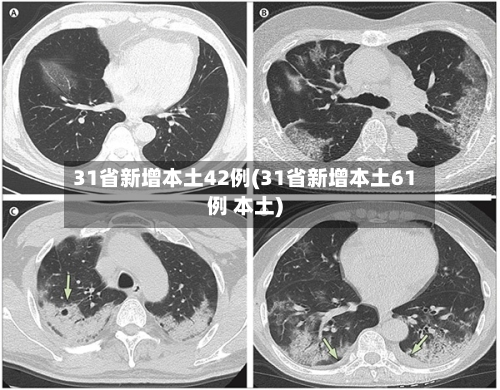 31省新增本土42例(31省新增本土61例 本土)-第2张图片