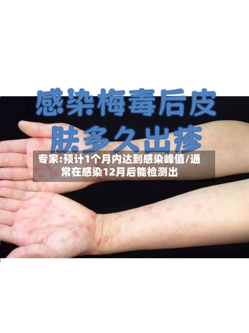 专家:预计1个月内达到感染峰值/通常在感染12月后能检测出-第3张图片
