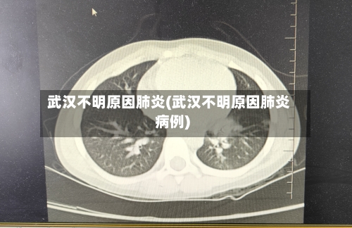 武汉不明原因肺炎(武汉不明原因肺炎病例)-第2张图片