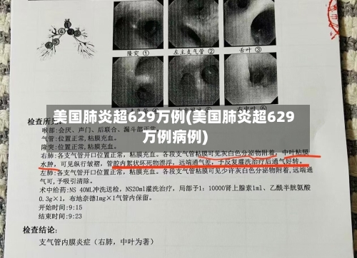 美国肺炎超629万例(美国肺炎超629万例病例)-第2张图片
